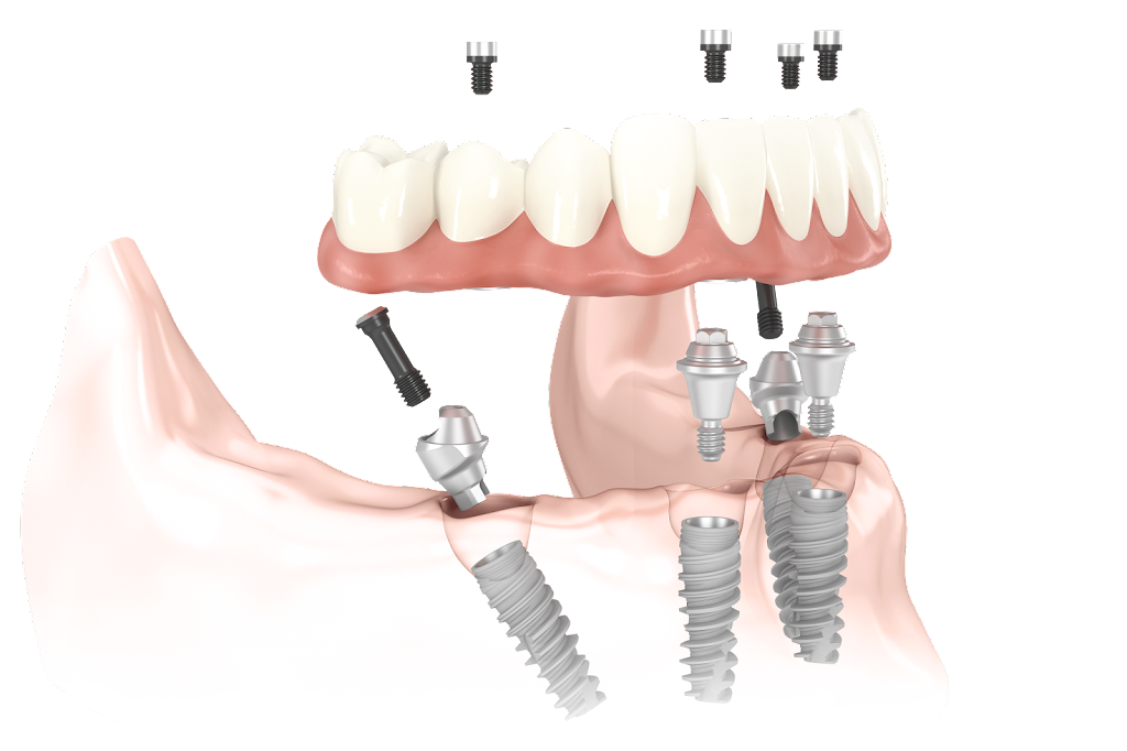 Sanger Implants | 1670 W Chapman Dr, Sanger, TX 76266, USA | Phone: (940) 458-5000