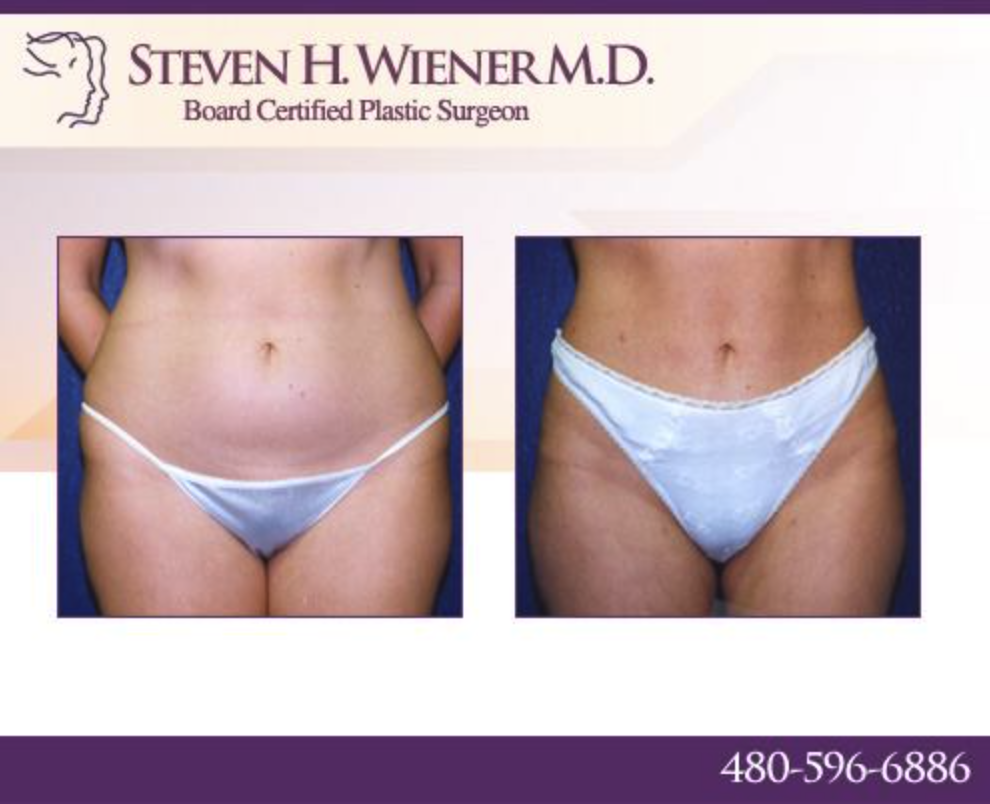 New Image Plastic Surgery: Steven H. Wiener, MD | 7425 E Shea Blvd Ste 105, Scottsdale, AZ 85260, USA | Phone: (480) 596-6886