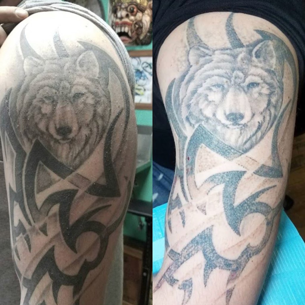 CS Tattoo Removal | 5 S Allen St #2201, Albany, NY 12208, USA | Phone: (518) 689-0730