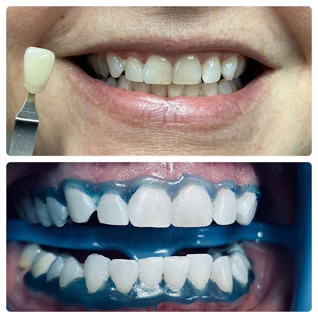 White Smiles Of Denton | 303 N Carroll Blvd, Denton, TX 76201, USA | Phone: (940) 594-3789