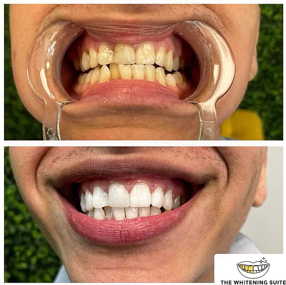 The Whitening Suite (Mobile Service only, We go to you) | 602 Mantoloking Rd Unit 2, Brick Township, NJ 08723, USA | Phone: (732) 859-7436