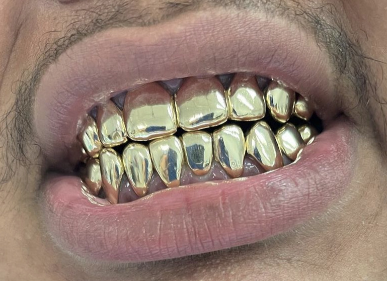 Gold Teeth Master | 3503 E Hillsborough Ave B, Tampa, FL 33610, USA | Phone: (813) 997-9247