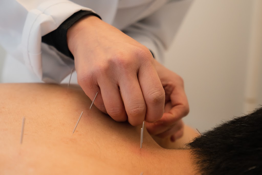 Grace Acupuncture | 930 Susquehanna Rd, Ambler, PA 19002 | Phone: (267) 957-4073