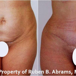 Dr Ruben B Abrams, MD, FACS | 9301 Wilshire Blvd Suite 402, Beverly Hills, CA 90210, USA | Phone: (310) 276-7777