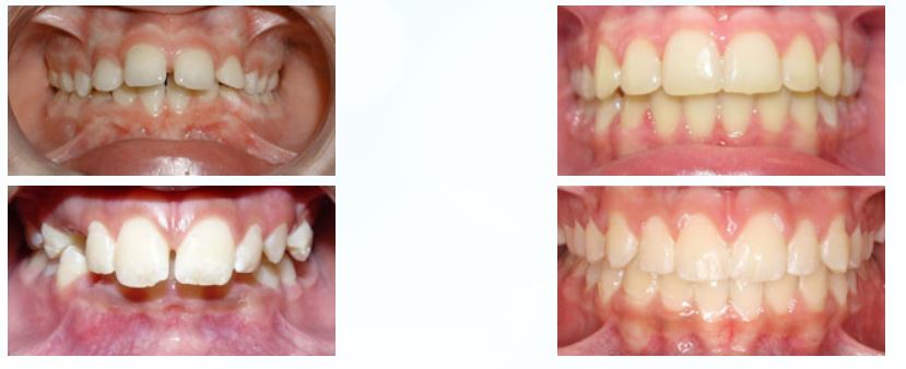 Central Texas Orthodontics - Dr. Brian St.Louis | 3413 W Slaughter Ln, Austin, TX 78748, USA | Phone: (512) 292-1910