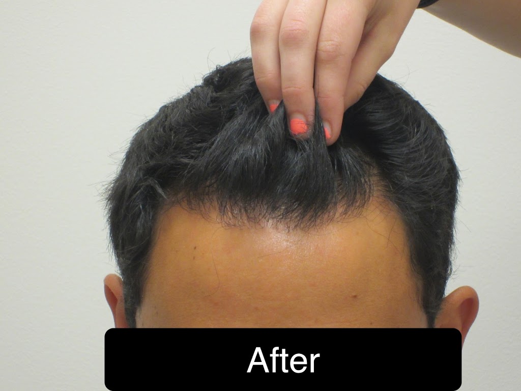 AZ Hair Restoration | 6400 Creedmoor Rd #104, Raleigh, NC 27613, USA | Phone: (919) 830-3778 AZ Hair Restoration | 6400 Creedmoor Rd #104, Raleigh, NC 27613, USA | Phone: (919) 830-3778