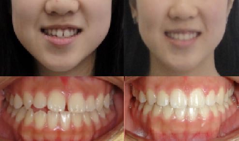 iCare Orthodontics | 97-16 Metropolitan Ave, Queens, NY 11375, USA | Phone: (718) 846-4400