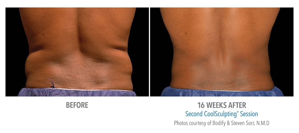 CoolSculpting of Dayton | 9240 Marketplace Dr, Miamisburg, OH 45342, USA | Phone: (937) 404-2665