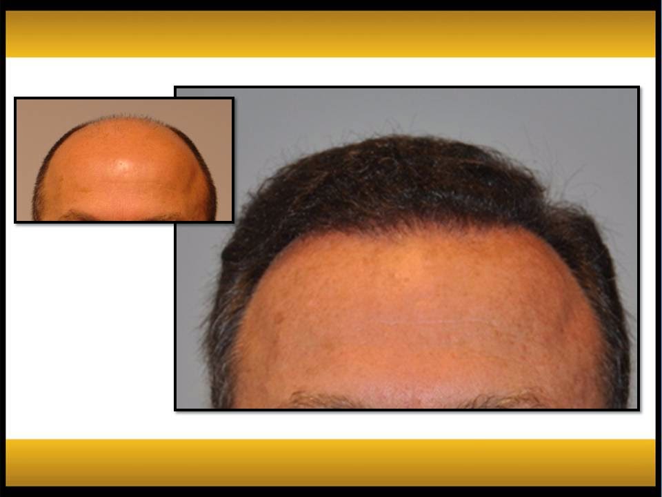 Fallon Hair Restoration | 9735 SW Shady Ln, Tigard, OR 97223, USA | Phone: (503) 941-5029