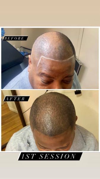 TBS SCALP MICROPIGMENTATION | 304 E 178th St, Bronx, NY 10457, USA | Phone: (646) 655-8483