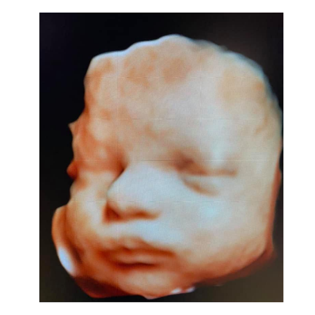 Life Imaging 3d 4d HD Ultrasound Studio | 471 Mariner Blvd, Spring Hill, FL 34609, USA | Phone: (352) 573-5141