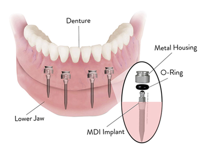 Mini Dental Implant Solutions Homewood, IL | 18243 Harwood Ave #1, Homewood, IL 60430, USA | Phone: (708) 232-7872
